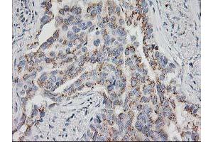 Immunohistochemical staining of paraffin-embedded Carcinoma of Human lung tissue using anti-HOXC11 mouse monoclonal antibody. (HOXC11 抗体)