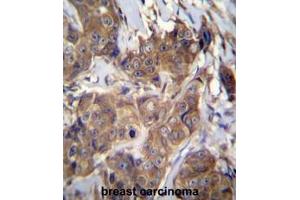 ATP6V1B1 Antibody (C-term) immunohistochemistry analysis in formalin fixed and paraffin embedded human breast carcinoma followed by peroxidase conjugation of the secondary antibody and DAB staining. (ATP6V1B1 抗体  (C-Term))