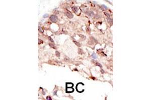 Formalin-fixed and paraffin-embedded human cancer tissue reacted with the SUV39H2 polyclonal antibody  , which was peroxidase-conjugated to the secondary antibody, followed by DAB staining. (SUV39H2 抗体  (AA 308-337))