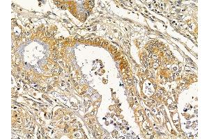 ABIN7093122 and ABIN7098213 at 1/100 staining human gastric cancer by IHC-P. (DLEU1 抗体  (C-Term))