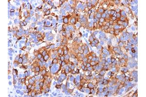 Formalin-fixed, paraffin-embedded human Melanoma stained with MART-1 / Melan-A Mouse Monoclonal Antibody (A103). (MLANA 抗体)