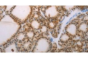 Immunohistochemistry of paraffin-embedded Human thyroid cancer tissue using S100A1 Polyclonal Antibody at dilution 1:70 (S100A1 抗体)
