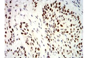 Immunohistochemical analysis of paraffin-embedded esophageal cancer tissues using UHRF1 mouse mAb with DAB staining. (UHRF1 抗体  (AA 616-755))