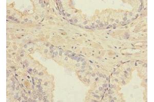 Immunohistochemistry of paraffin-embedded human prostate cancer using ABIN7171878 at dilution of 1:100 (TSPAN4 抗体  (AA 107-201))