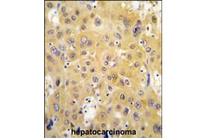 Formalin-fixed and paraffin-embedded human hepatocarcinoma tissue reacted with ECGF1 antibody , which was peroxidase-conjugated to the secondary antibody, followed by DAB staining. (Thymidine Phosphorylase 抗体  (AA 318-345))