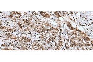 Immunohistochemistry of paraffin-embedded Human gastric cancer tissue using UPK3A Polyclonal Antibody at dilution of 1:30(x200) (Uroplakin 3A 抗体)