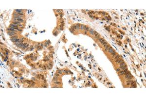 Immunohistochemistry of paraffin-embedded Human colon cancer tissue using HTR3A Polyclonal Antibody at dilution 1:50 (Serotonin Receptor 3A 抗体)