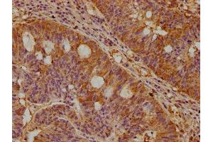 IHC image of ABIN7169092 diluted at 1:300 and staining in paraffin-embedded human pancreatic cancer performed on a Leica BondTM system. (NEK1 抗体  (AA 1-104))