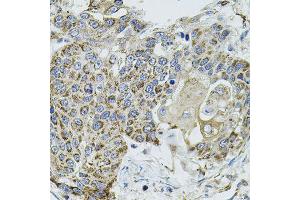 Immunohistochemistry of paraffin-embedded human lung cancer using VEPH1 antibody (ABIN5974616) (40x lens). (VEPH1 抗体)