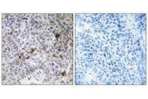 Immunohistochemistry analysis of paraffin-embedded human lung carcinoma tissue using RAB11FIP3 antibody. (RAB11FIP3 抗体  (C-Term))