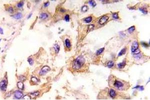 Immunohistochemistry (IHC) analyzes of p-eIF4E in paraffin-embedded human breast carcinoma tissue. (EIF4E 抗体  (pSer209))