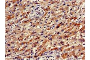 Immunohistochemistry of paraffin-embedded human liver cancer using ABIN7161673 at dilution of 1:100 (Olfactomedin 1 抗体  (AA 374-441))