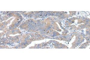 Immunohistochemistry of paraffin-embedded Human esophagus cancer using RAB2A Polyclonal Antibody at dilution of 1/40 (RAB2A 抗体)
