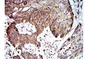 Immunohistochemical analysis of paraffin-embedded esophageal cancer tissues using UFD1L mouse mAb with DAB staining. (UFD1L 抗体  (AA 208-307))
