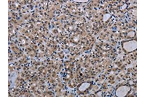 The image on the left is immunohistochemistry of paraffin-embedded Human thyroid cancer tissue using ABIN7191353(MAGEC1 Antibody) at dilution 1/30, on the right is treated with synthetic peptide. (MAGEC1 抗体)