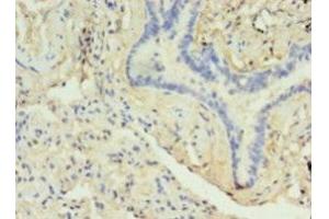 Immunohistochemistry of paraffin-embedded human lung cancer using ABIN7149470 at dilution of 1:100 (DRD5 抗体  (AA 361-477))