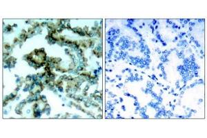 Immunohistochemical analysis of paraffin-embedded human lung carcinoma tissue, using PKCβ (phospho-Thr641) antibody (E011172). (PKC beta 抗体  (pThr641))