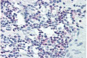Human Colon, Lymphocytes (formalin-fixed, paraffin-embedded) stained with PLCG1 antibody ABIN337039 at 1:25-1:100 followed by biotinylated goat anti-rabbit IgG secondary antibody ABIN481713, alkaline phosphatase-streptavidin and chromogen. (Phospholipase C gamma 1 抗体  (C-Term))