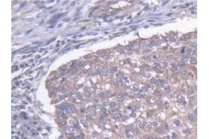 Detection of MAP1B in Human Lung cancer Tissue using Polyclonal Antibody to Microtubule Associated Protein 1B (MAP1B)