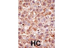 Formalin-fixed and paraffin-embedded human cancer tissue reacted with the primary antibody, which was peroxidase-conjugated to the secondary antibody, followed by DAB staining.