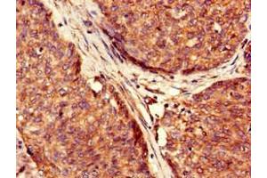 Immunohistochemistry of paraffin-embedded human ovarian cancer using ABIN7174352 at dilution of 1:100 (USP6 抗体  (C-Term))