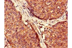 Immunohistochemistry of paraffin-embedded human ovarian cancer using ABIN7174352 at dilution of 1:100