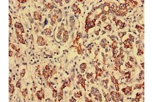 Immunohistochemistry analysis of human breast cancer using ABIN7168269 at dilution of 1:100 (RTCD1 抗体  (AA 167-379))