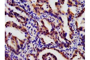 IHC image of ABIN7173883 diluted at 1:180 and staining in paraffin-embedded human lung cancer performed on a Leica BondTM system. (LTBR 抗体  (AA 31-224))