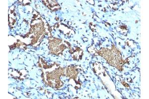 Formalin-fixed, paraffin-embedded human Angiosarcoma stained with Glycophorin A Rabbit Recombinant Monoclonal Antibody (GYPA/1725R). (Recombinant CD235a/GYPA 抗体)