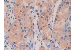 Detection of ANGPTL4 in Human Stomach cancer Tissue using Polyclonal Antibody to Angiopoietin Like Protein 4 (ANGPTL4) (ANGPTL4 抗体  (AA 182-388))