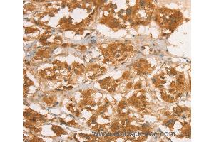 Immunohistochemistry of Human breast cancer using CPB1 Polyclonal Antibody at dilution of 1:50 (CPB1 抗体)