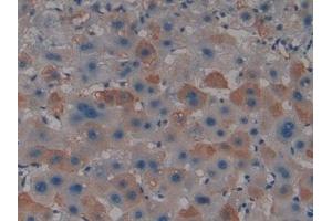 Detection of PADI4 in Human Liver cancer Tissue using Polyclonal Antibody to Peptidyl Arginine Deiminase Type IV (PADI4) (PAD4 抗体  (AA 1-300))