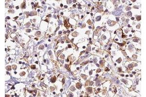ABIN6277670 at 1/100 staining Human breast cancer tissue by IHC-P. (CTNNA1 抗体  (Internal Region))