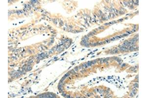 The image on the left is immunohistochemistry of paraffin-embedded Human colon cancer tissue using ABIN7131272(SYT5 Antibody) at dilution 1/15, on the right is treated with fusion protein. (Synaptotagmin V 抗体)