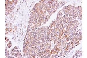 IHC-P Image Immunohistochemical analysis of paraffin-embedded human endometrial cancer, using cGK1, antibody at 1:500 dilution. (PRKG1 抗体  (Center))