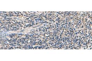 Immunohistochemistry of paraffin-embedded Human cervical cancer tissue using ATP5F1D Polyclonal Antibody at dilution of 1:55(x200) (ATP5F1D 抗体)