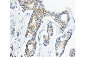 IHC-P: CD1d antibody testing of human breast cancer tissue (CD1d 抗体  (AA 76-92))