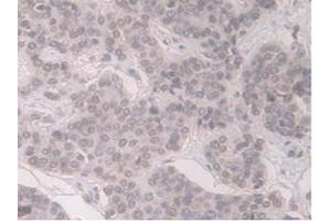 DAB staining on IHC-P;Samples:Human Pancreas Cancer Tissue) (ORM1 抗体  (AA 19-201))