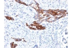 IHC staining of FFPE human gastric carcinoma with recombinant Gastric Mucin antibody (clone MUC6/1553R). (MUC6 抗体)
