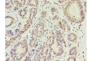 Immunohistochemistry of paraffin-embedded human breast cancer using ABIN7157372 at dilution of 1:100 (Cytokeratin 1 抗体  (AA 1-584))
