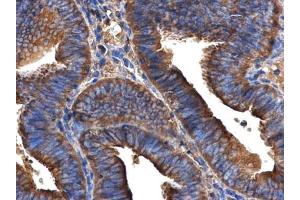 IHC-P Image ARFIP2 antibody [N1C2] detects ARFIP2 protein at cytoplasm in human endometrial cancer by immunohistochemical analysis. (ARFIP2 抗体)