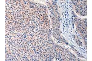 The image on the left is immunohistochemistry of paraffin-embedded Human liver cancer tissue using ABIN7190632(FAT4 Antibody) at dilution 1/20, on the right is treated with synthetic peptide. (FAT4 抗体)