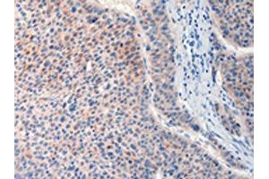 The image on the left is immunohistochemistry of paraffin-embedded Human liver cancer tissue using ABIN7190632(FAT4 Antibody) at dilution 1/20, on the right is treated with synthetic peptide.