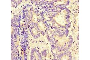 Immunohistochemistry of paraffin-embedded human colon cancer using ABIN7165797 at dilution of 1:100 (MAX 抗体  (AA 1-58))