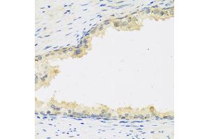 Immunohistochemistry of paraffin-embedded human prostate using LIF antibody (ABIN5974705) at dilution of 1/100 (40x lens). (LIF 抗体)