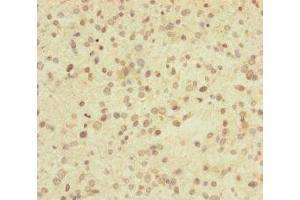 Immunohistochemistry of paraffin-embedded human glioma using ABIN7174279 at dilution of 1:100 (USP2 抗体  (C-Term))