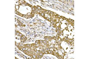Immunohistochemistry of paraffin-embedded human lung cancer using β-Tubulin Rabbit pAb (ABIN3020552, ABIN3020553 and ABIN3020554) at dilution of 1:250 (40x lens).