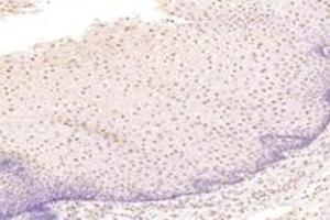 Immunohistochemistry analysis of paraffin-embedded human esophageal cancer using TBX10 (ABIN7075814) at dilution of 1: 4600 (T-Box 10 抗体)