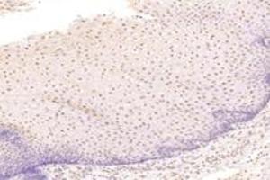 Immunohistochemistry analysis of paraffin-embedded human esophageal cancer using TBX10 (ABIN7075814) at dilution of 1: 4600