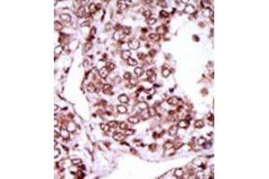 Formalin-fixed and paraffin-embedded human cancer tissue (hepatocarcinoma) reacted with the primary antibody, which was peroxidase-conjugated to the secondary antibody, followed by AEC staining. (CAMKII gamma 抗体  (C-Term))